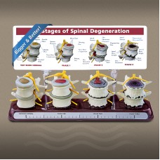 Stages of Spine Degeneration Model 