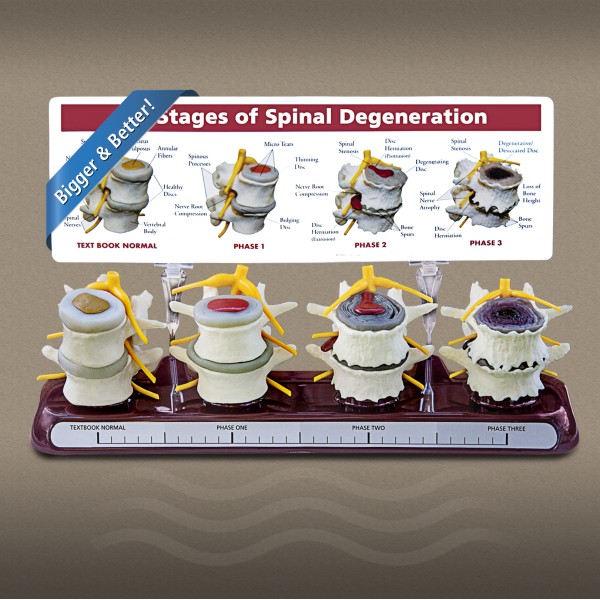 Stages of Spine Degeneration Model 